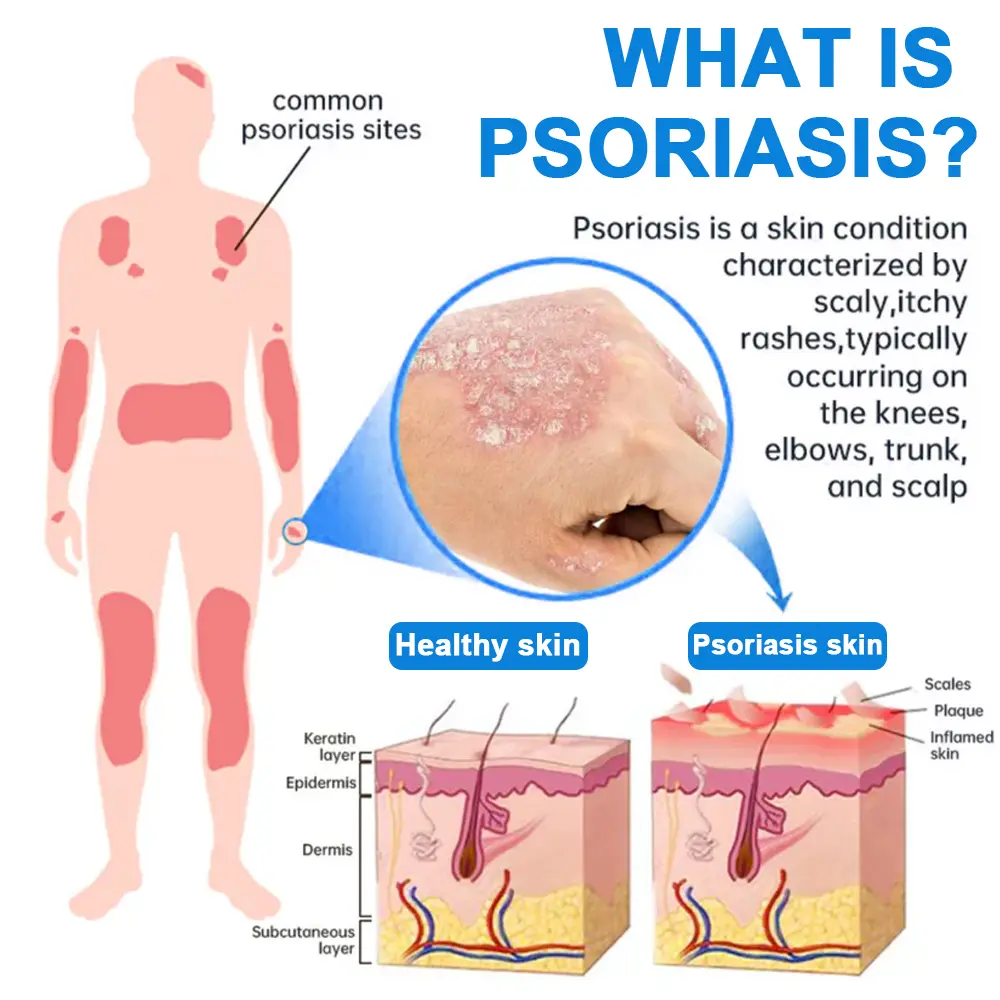 Cvreoz® Magnesium Herbal Psoriasis Spray 👨⚕️ FDA Approved