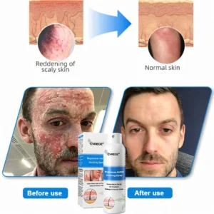 Cvreoz® Magnesium Herbal Psoriasis Spray 👨⚕️ FDA Approved