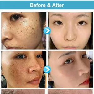 （🔥LAST DAY SALE-80% OFF) HZA™ Concentrated potent skin tag removal cream