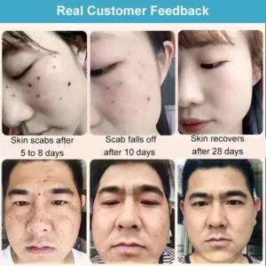 （🔥LAST DAY SALE-80% OFF) HZA™ Concentrated potent skin tag removal cream