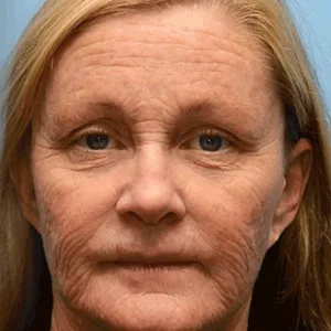 LOVILDS® Botox Bee Venom Wrinkle Removal Cream