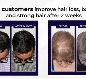 🔥(Last Day SAVE 60% OFF)LOVILDS Natural Hair Regrowth Spray