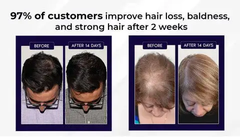 🔥(Last Day SAVE 60% OFF)LOVILDS Natural Hair Regrowth Spray