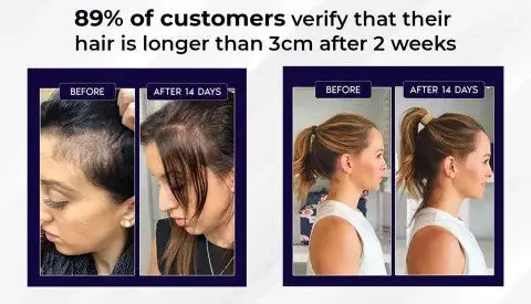 🔥(Last Day SAVE 60% OFF)LOVILDS Natural Hair Regrowth Spray