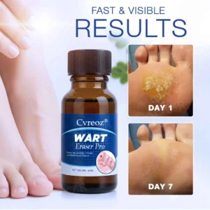 🔥Warts No More - 50% OFF | Cvreoz® Wart Eraser Pro (Copy)