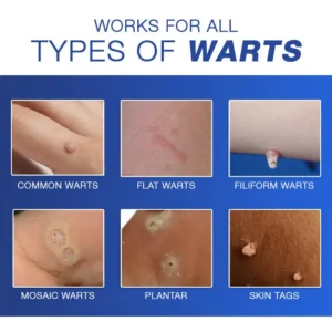 🔥Warts No More - 50% OFF | Cvreoz® Wart Eraser Pro (Copy)