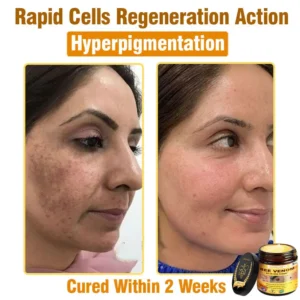 𝐋𝐎𝐕𝐈𝐋𝐃𝐒™ 𝐁𝐞𝐞 𝐕𝐞𝐧𝐨𝐦 𝐀𝐥𝐥-𝐢𝐧-𝐎𝐧𝐞 𝐂𝐫𝐞𝐚𝐦–🌸 Anti-aging,Hydrating, Skin Repair, Even Tone, Acne and Dark Spot Treatment, Wart and Mole Removal, Psoriasis Relief