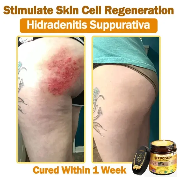 LOVILDS™ 𝐁𝐞𝐞 Poison 𝐀𝐥𝐥-𝐢𝐧-𝐎𝐧𝐞 𝐂𝐫𝐞𝐚𝐦