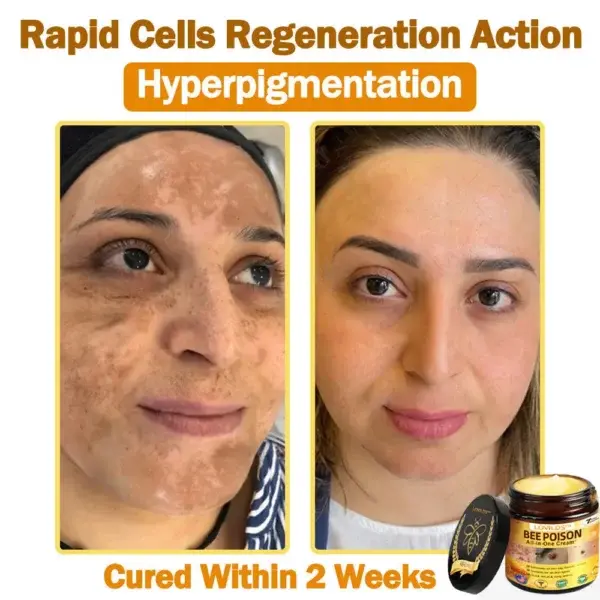 LOVILDS™ 𝐁𝐞𝐞 Poison 𝐀𝐥𝐥-𝐢𝐧-𝐎𝐧𝐞 𝐂𝐫𝐞𝐚𝐦