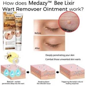 ✅✅Medazy™ Bee Lixir Wart Remover Ointment