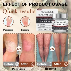 🔥 Flash Sale: LOVILDS® KeraErase Dual-Action Renewal Cream