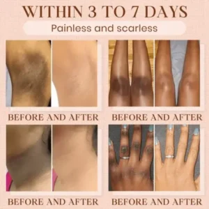 Cvreoz® Purifying Exfoliating Gel for Acanthosis Nigricans, Exfoliation, Dark Spots, Skin Tags, and Eczema