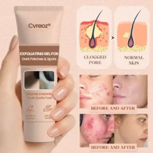 Cvreoz® Purifying Exfoliating Gel for Acanthosis Nigricans, Exfoliation, Dark Spots, Skin Tags, and Eczema