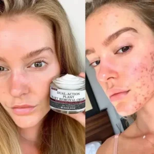 LOVILDS™ Black Rice Skin Repair Cream – Clinically Tested Wart & Skin Tag Remover