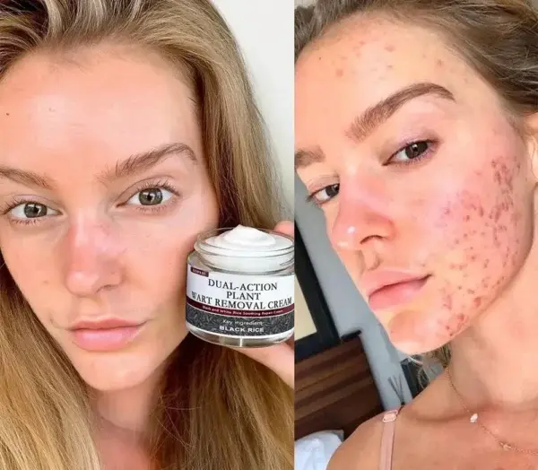 LOVILDS™ Black Rice Skin Repair Cream – Clinically Tested Wart & Skin Tag Remover