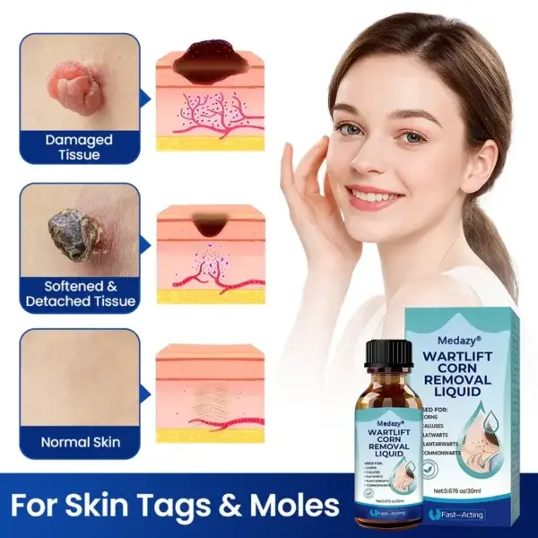 Medazy® WartLift Corn Removal Liquid